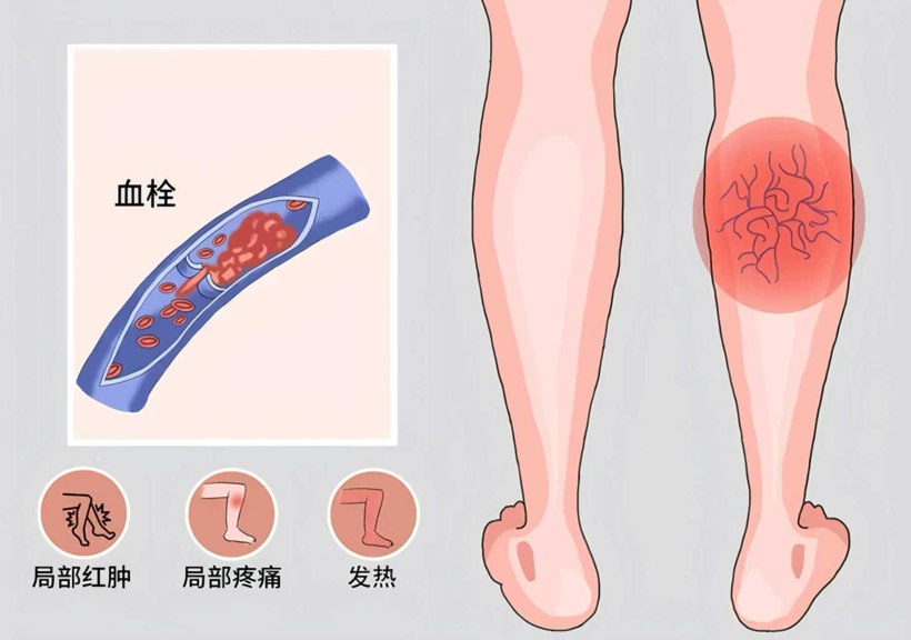 【医学科普】肾友必读：你的血液为何会“凝固” 肾病下肢静脉血栓健康指导
