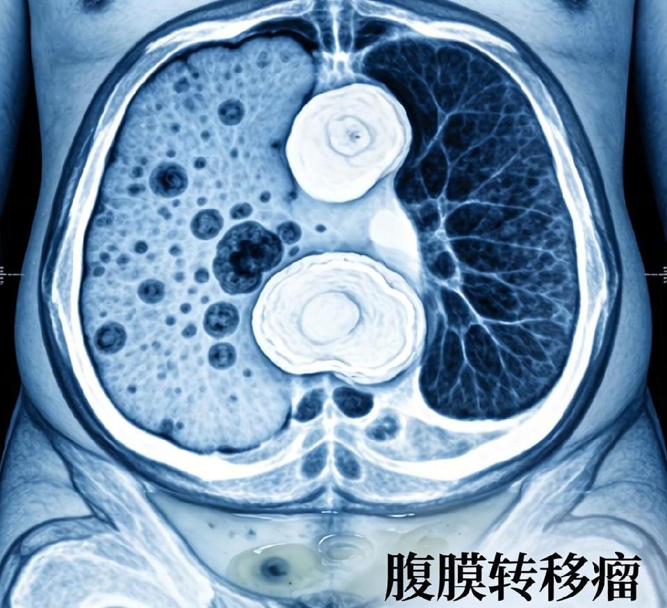 【医学科普】腹膜转移瘤的特性解析与治疗新探索